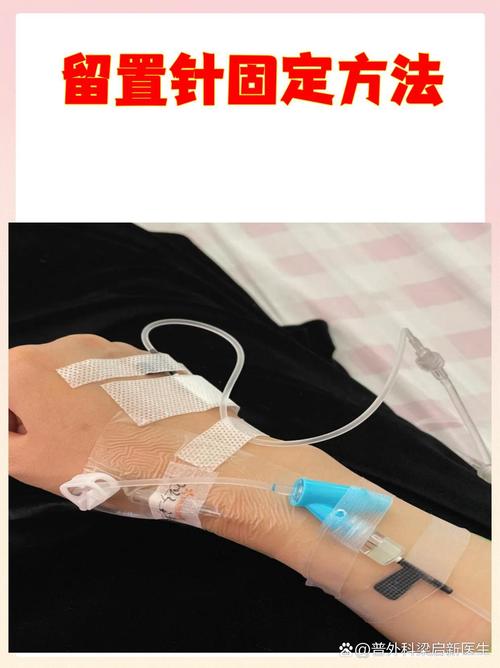 做好皮肤准备、导管塑形与敷料使用 有效减少导管移位、渗液和感染